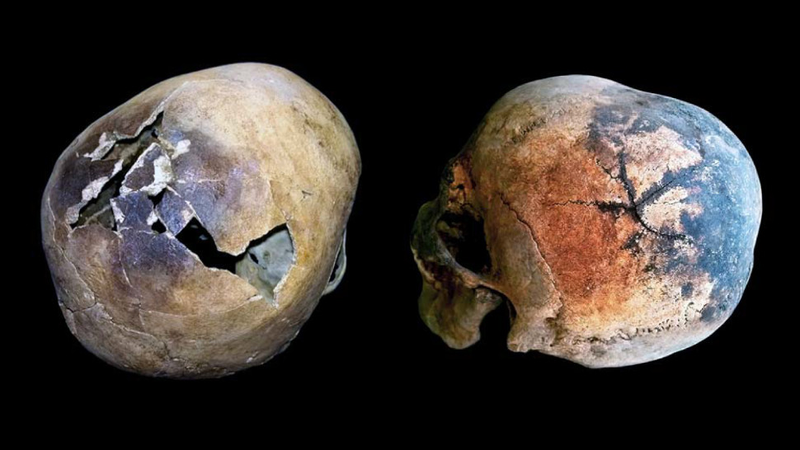 Skulls exhibiting fractures consistent with an exploding brain.